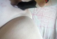 treatment arthritus of thumb